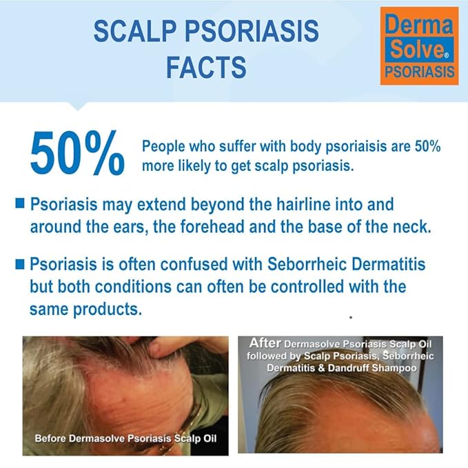 Scalp Psoriasis & Dandruff Shampoo and Conditioner by DermaSolve - Seborrheic Dermatitis Products - Naturally Heals Itchy Flakey Inflamed Skin and Provides Soothing Moisturizing Relief