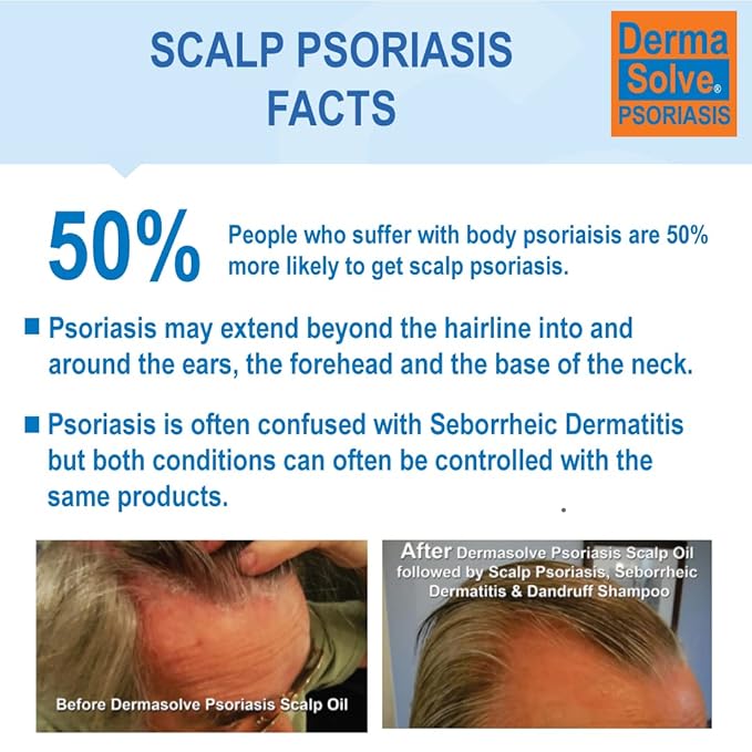 DermaSolve Scalp Psoriasis & Dandruff free Medicated Shampoo with Conditioner, Ultimate Seborrheic Dermatitis Treatment for Itchy, Flakey Scalp, Soothing & Moisturizing Relief
