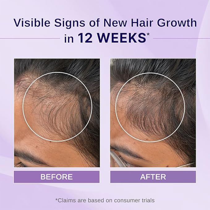 Bare Anatomy Nature x Science Rosemary Hibiscus Hair Growth Oil for Women & Men | Helps Hair Growth & Strengthens Hair | Nourishes Scalp & Controls Hair Fall | Suitable for All Hair Types-100ml