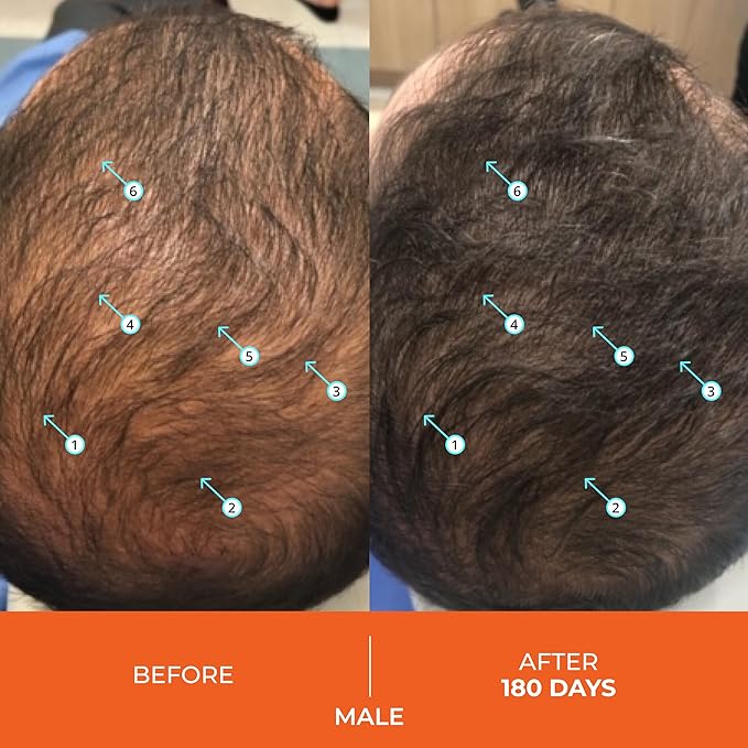 DS Labs Revita Hair Vitamin Gummies - Support for Thicker, Fuller Looking Hair, With Biotin, Zinc, Vitamin D, Iron, Magnesium & Melatonin, Vegan, Gluten-Free, Gelatin-Free, 60 Gummies