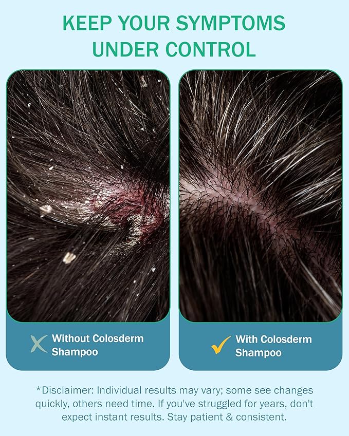 Eczema Cream Shampoo Treatment for Sensitive Skin for Kids & Adults- Colostrum & Colloidal Oatmeal -Itchy Scalp Anti Dandruff Eczema Shampoo for Scalp Women & Men, 16 fl oz, Made in USA