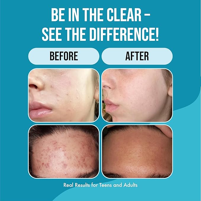 Teenology Teen Shampoo – Avoid Acne Breakouts, Non-Comedogenic, For Dry & Oily Scalps, Sulfate & Paraben Free, Natural Botanical Extracts, for Clear Skin & Healthy Hair, 16 oz – (Vanilla Almond)