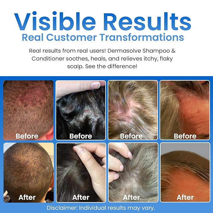 Dermasolve Psoriasis, Seborrheic Dermatitis & Dandruff Shampoo plus Conditioner. Naturally Heals Itchy Flakey Inflamed Skin and Provides Soothing Moisturizing Relief. (8.0 oz)