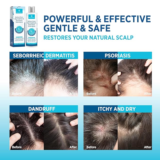 Roycederm Seborrheic Dermatitis & Psoriasis Shampoo and Conditioner Set - Effective Scalp Treatment for Folliculitis, Psoriasis, Dandruff, Dry Itchy Scalp - Soothing, Moisturizing Herbal Formula