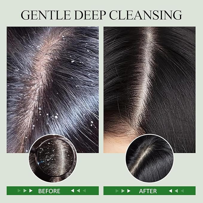 SHVYOG Scalp Scrub, Rosemary Scalp Exfoliator, Scalp Exfoliator Scrub for Build Up, Oily Hair, Hair Treatment Nourishing Detox Hair Care with Scalp Massager