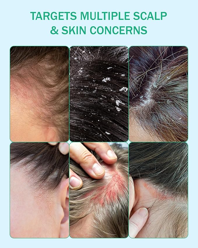 Eczema Cream Shampoo Treatment for Sensitive Skin for Kids & Adults- Colostrum & Colloidal Oatmeal -Itchy Scalp Anti Dandruff Eczema Shampoo for Scalp Women & Men, 16 fl oz, Made in USA